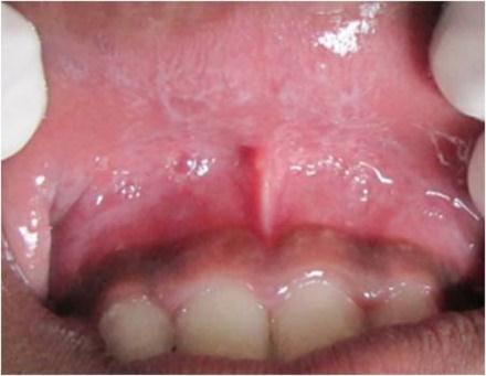 These were associated with severe itching for which he had taken Ayurvedic medicine. On examination, the patient had multiple carious teeth.