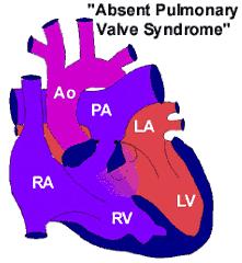 Absent Pulmonary Valve Syndrome Fact sheet on Absent Pulmonary Valve Syndrome In this condition, which has some similarities to Fallot's Tetralogy, there is a VSD with narrowing at the pulmonary