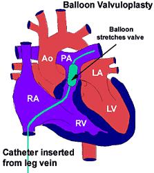If the problem is severe it may require treatment which usually involves stretching the valve with a balloon catheter (Balloon Valvuloplasty) Balloon Valvuloplasty A heart catheter, with