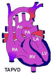 Total Anomalous Pulmonary Venous Drainage The Pulmonary Veins, which carry blood back to the heart after it has