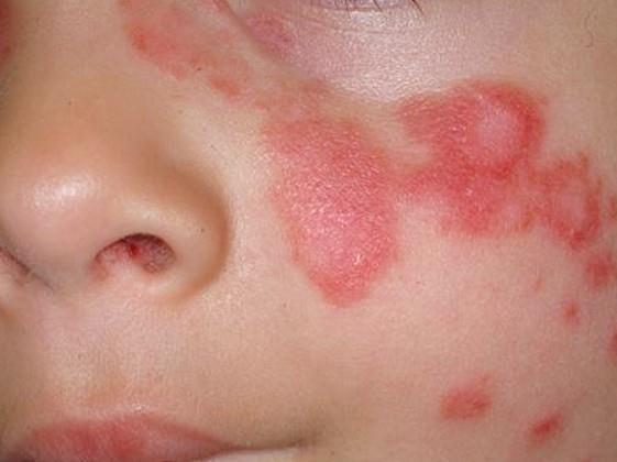 Discoid lupus Localized to the skin.