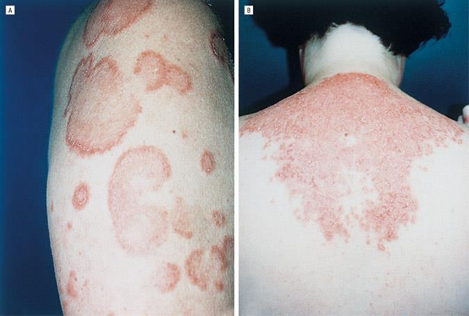 Drug induced lupus Caused by a medication triggering the immune system.
