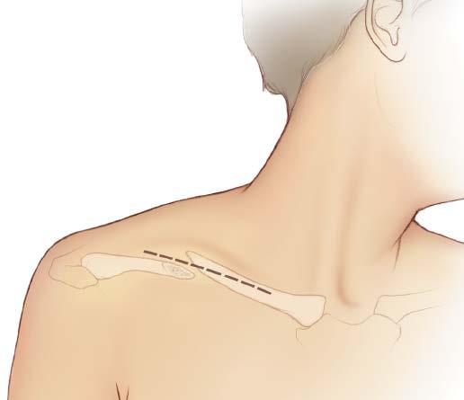 surgical Technique 2 Approach The horizontal incision is placed over the superior or inferior clavicle, depending on the stabilization method.