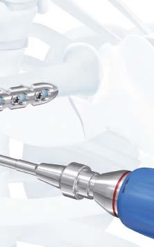 Verify the drill bit angle under fluoroscopy to ensure the desired angle has been achieved.