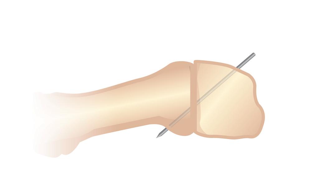 Surgical Technique 1. Expose the 1 st metatarsal-cuneiform (MC) joint following a lateral release at the 1st metatarsal-phalangeal (MTP) joint.