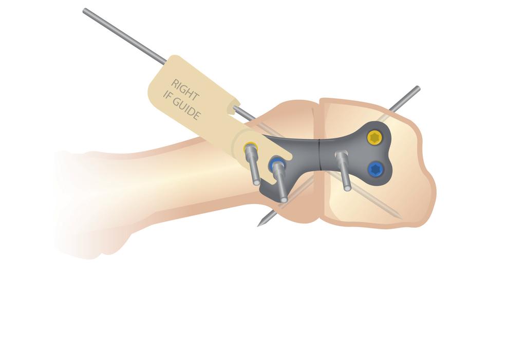 8. Similarly, measure and insert a Locking Bone Screw in the proximal, inferior bone plate hole.