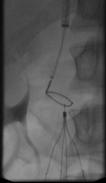 IVC Filter IVC filters 400 patients randomized to filter or no filter (also LMWH)