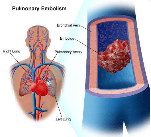 free and become lodged in the blood vessels of the lung, causing PE Pulmonary Embolism (PE) >600,000 cases per year1 About 12% death occurs