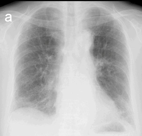 Fig. 1 Chest X-ray and computed tomography scan on admission, showing reticulonodular shadows at the base of both the lungs. Fig.