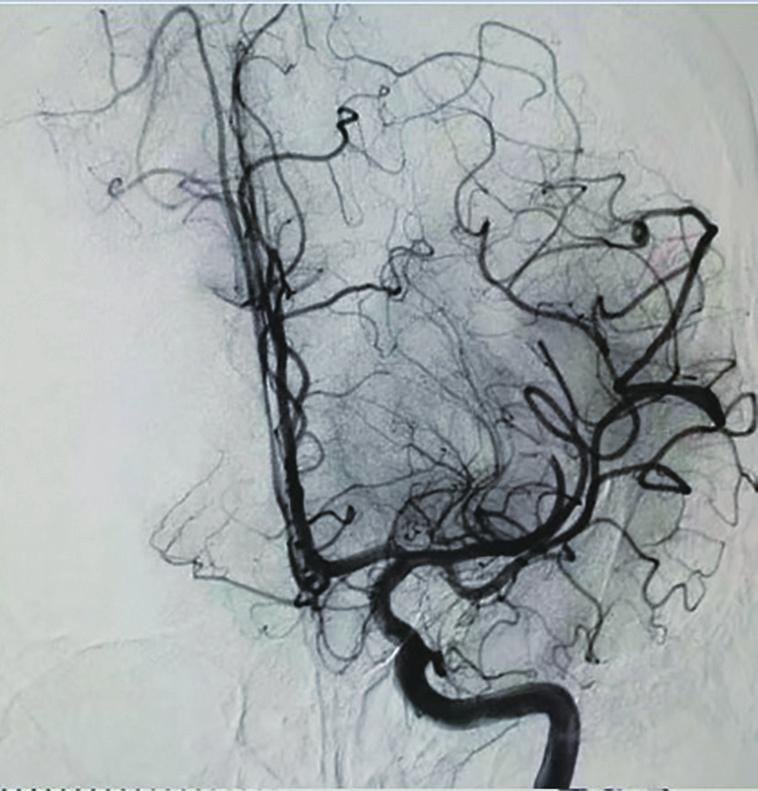 AME Medical Journal, 2018 Page 3 of 10 A B C Figure 1 Cerebral angiography before and after thrombectomy in patients with MCA occlusion (A) showing occlusion of the proximal MCA; (B) final angiogram