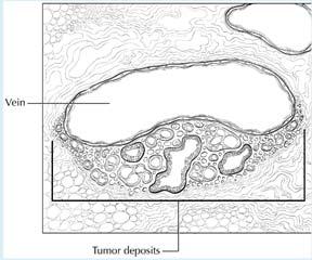 Tumor Deposits 93 Mesenteric Pericolonic Perirectal Subserosa All Regional Lymph Nodes Negative Deposits + LNs N1c = Tumor deposit(s) in