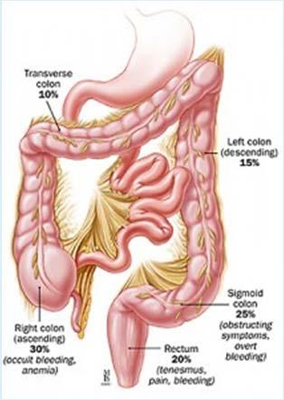 Anatomy 17 ACS Colorectal Cancer Facts & Figures 2014-2016 and http://fcrc-archives.