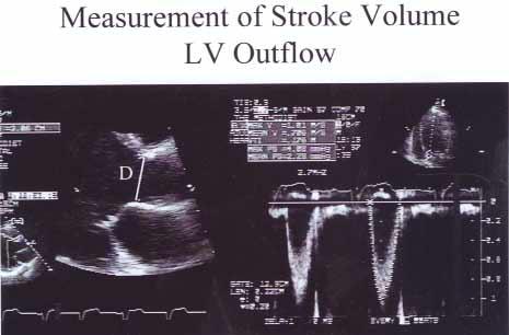aortic valve, just proximal to the region of flow acceleration into the jet.