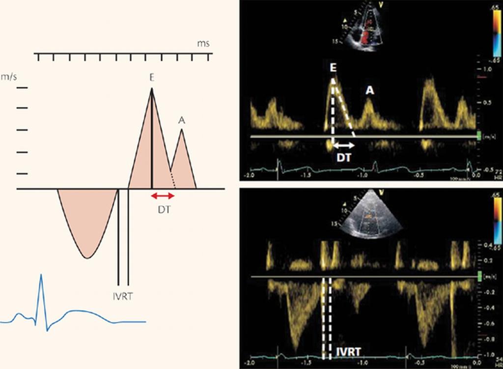 Mitral valve inflow Pulsed- wave (PW) Doppler is performed in the apical 4- chamber view to obtain mitral inflow veloci1es to assess LV