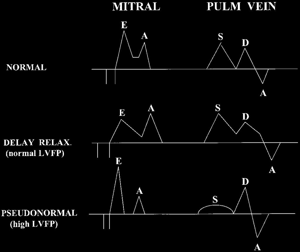 Tissue Doppler Imaging of the LV Myocardial velocity recording obtained