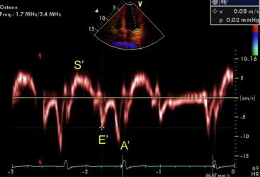 Recording shows systolic posi1ve wave (S), early diastolic wave (E ),