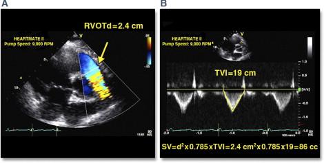 TVI RVOT The TVI at RVOT is obtained by placing a 1- to