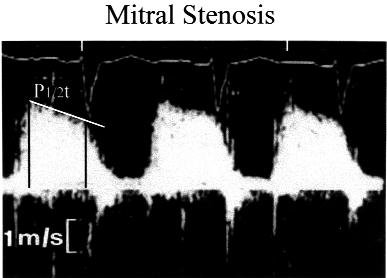 Mitral stenosis: PHT CW Doppler tracing taken from a pa1ent with mitral stenosis, illustra1ng measurement of