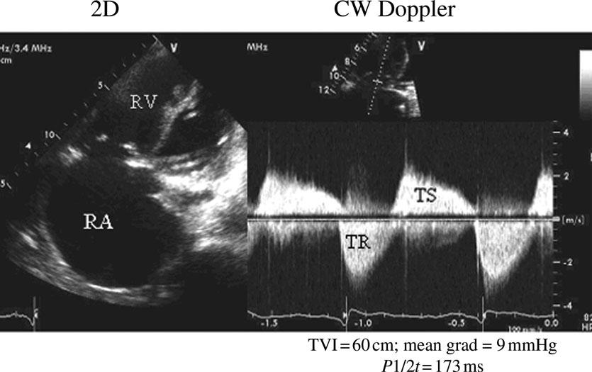 Tricuspidal stenosis The evaluation of stenosis severity is primarily done using the haemodynamic information provided by CWD.