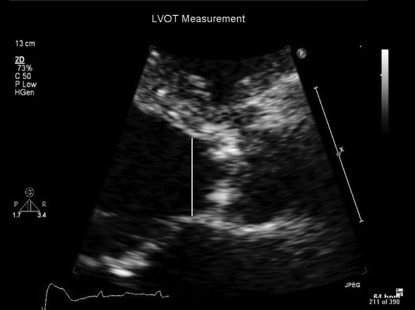 Left ventricular outflow tract Left ventricular outflow tract diameter is measured in the parasternal long-axis view in mid-systole from the white