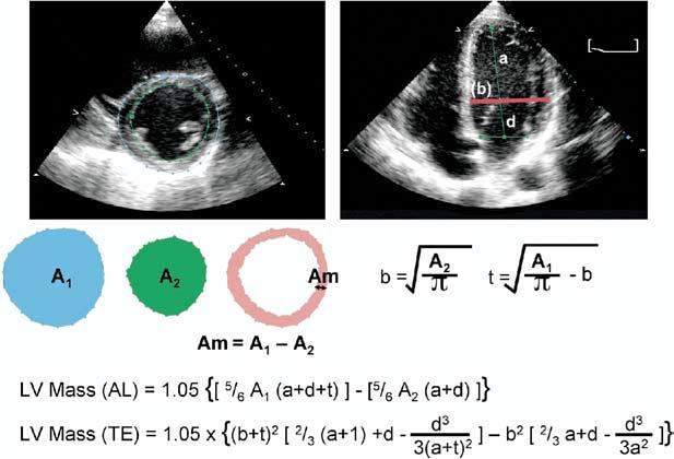 Left ventricular volumes Two-dimensional measurements for volume calculations