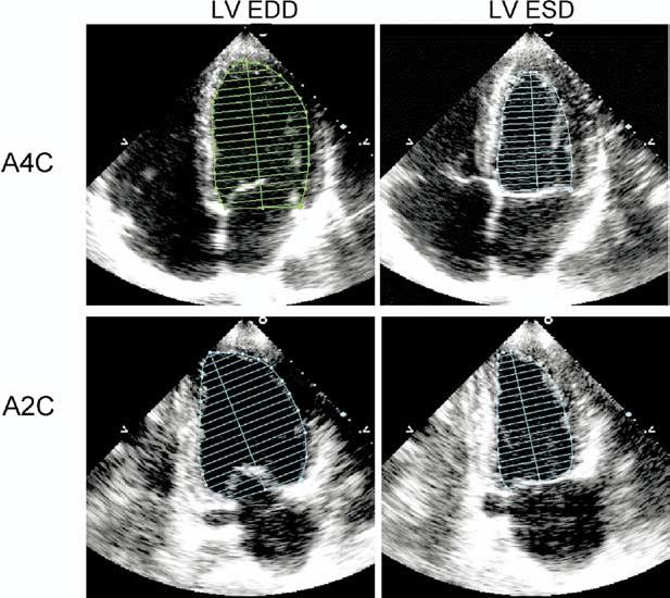 (A4C) and apical 2-chamber (A2C) views at end diastole (LV EDD) and at end