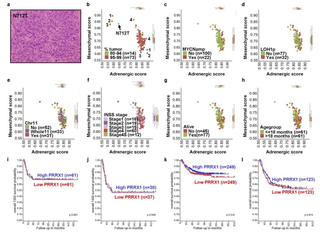 Supplementary Figure 8 Relationship between the MES and ADRN signature scores and molecular and clinical variables and the prognostic value of PRRX1 in a series of 122 primary neuroblastoma tumors.