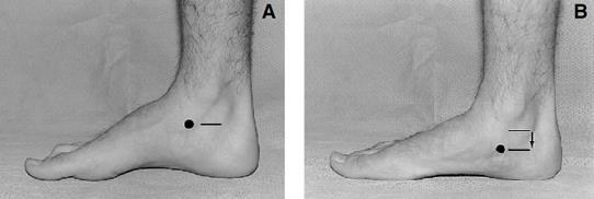 Risk factors Medial tibial stress syndrome A key risk factor is navicular