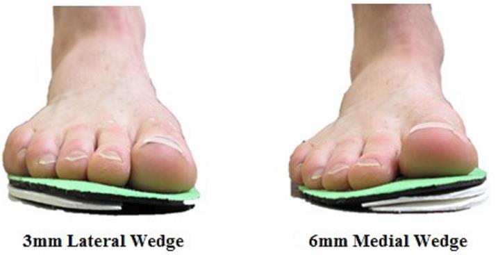 Foot orthoses reduce patellofemoral pain 27 runners randomised to: 3 mm lateral wedge 6 mm medial wedge Follow-up at 6 weeks