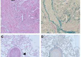 Extratumoral Vascular Invasion is a Significant Prognostic Factor in Resected