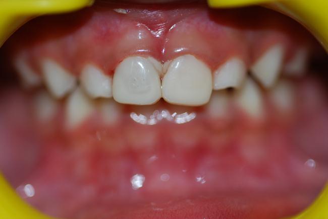 By priming the inside of the relined crown it can be bonded to the tooth using composites or GIC. 5.
