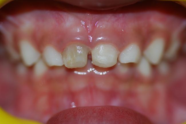 Case 2: Patient ( Male, 4 years) reported with composite