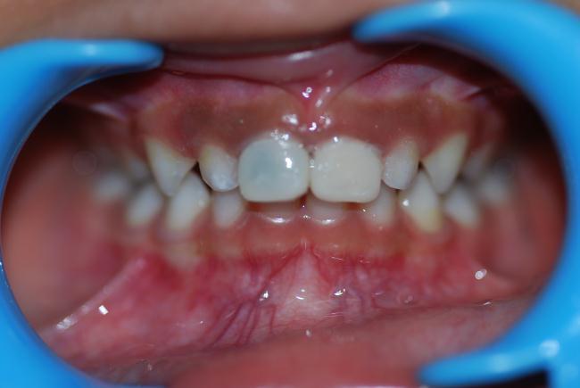 the C/O Discolored front teeth.