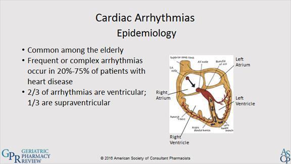 1.7 Cardiac Arrhythmias In a normal heart, the sinoatrial (SA) node generates electrical impulses that spread as a wave of depolarization through the atria and to the atrioventricular (AV) node.