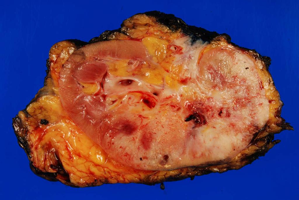 Kidney: Staging Changes T2 split T2a ( 7cm < T <= 10cm) vs.