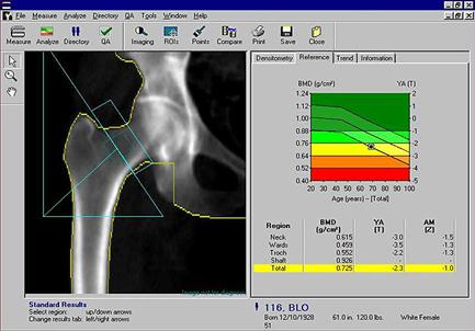 You have to choose your site: I prefer the femoral neck Femoral neck z