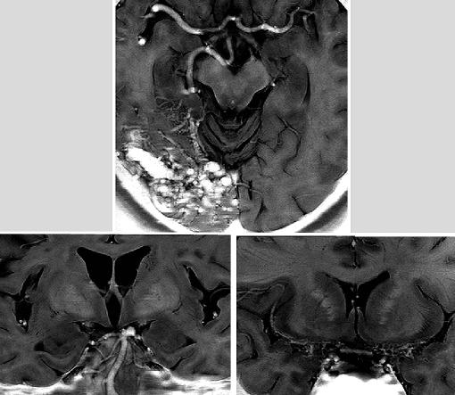 Fig. 1. Left: Coronal MR image of normal brain in a 39-year-old woman, showing detailed structures of the vertebrobasilar artery system.