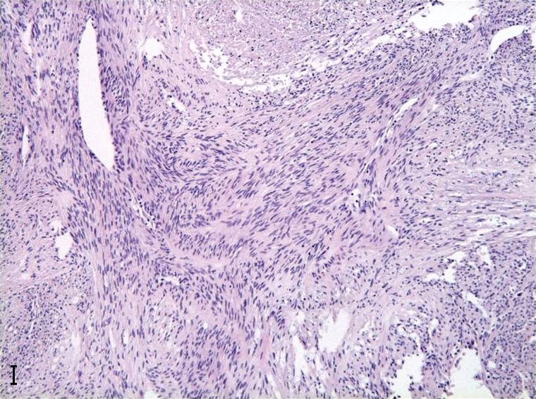 One variant of the fibrocollagenous type, the palisading dermatofibroma, has nuclear palisading and prominent verocay-like bodies in part of the lesion12.