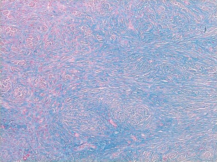 (C) Mucin deposition in the cellular type (alcian blue, 40). subcutaneous tissue. In addition, the aneurysmal type was statistically significant with respect to the depth of invasion (p<0.05).