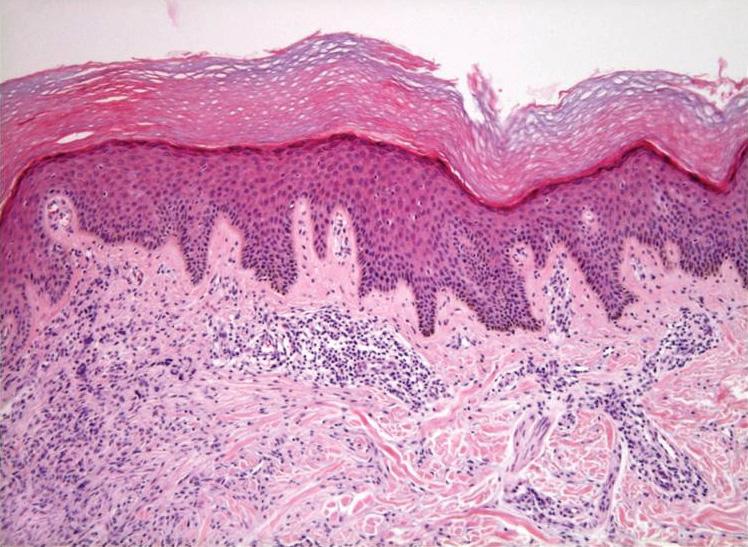 Dermatofibromas, including the variants, may be associated with acanthosis or hyperplasia of the overlying epidermis and hyperpigmentation of the basal layer 22.