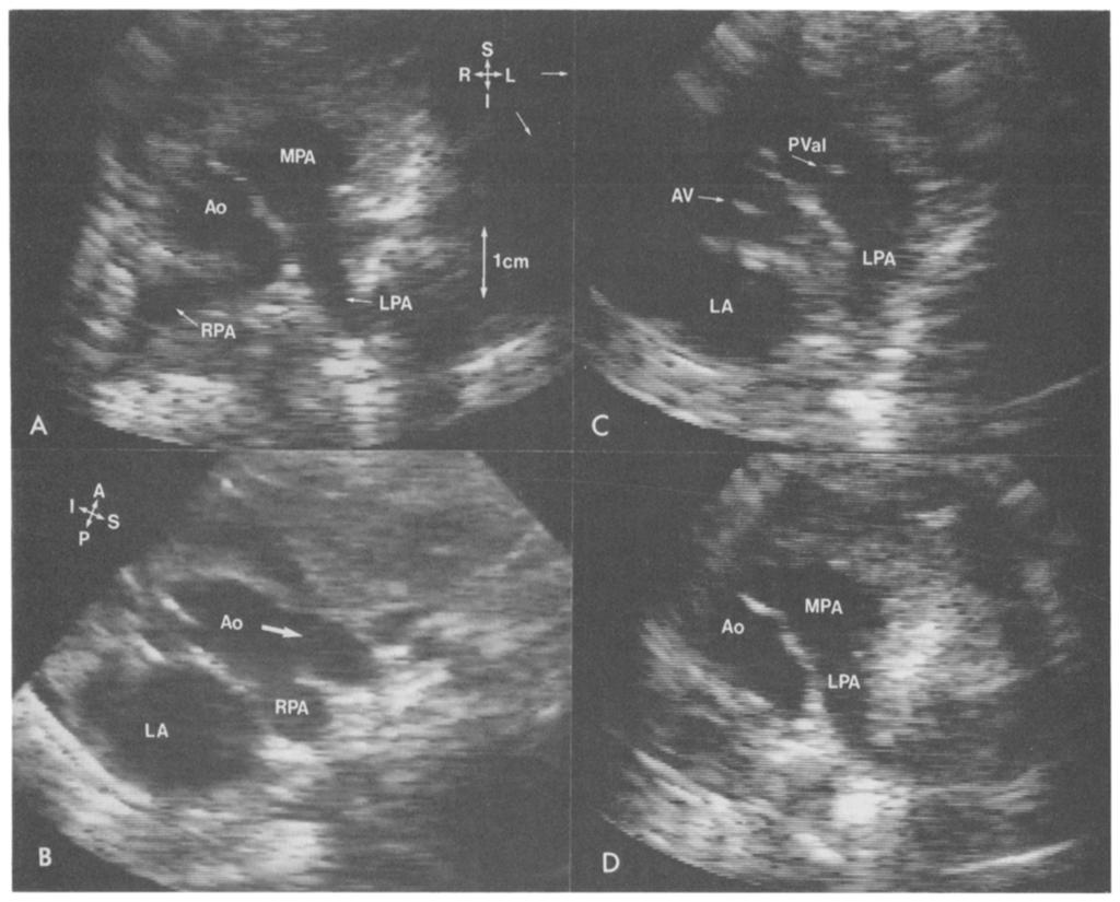 (LPA) pulmonary arteries. B, Parasternal long-axis scan of the ascending aorta (Ao) (white arrow) and the abnorm al origin of the right pulmonary artery (RPA) from it.