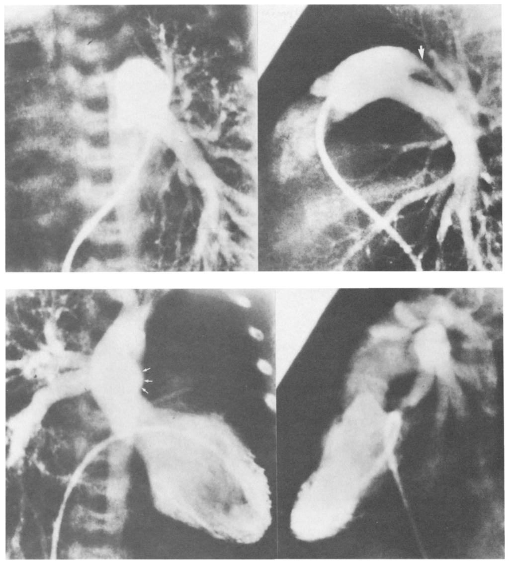 in truncus arteriosus. If the right conotruncal ridge arises more posteriorly than normal, unequal partitioningof the aortopulmonary trunk may occur.