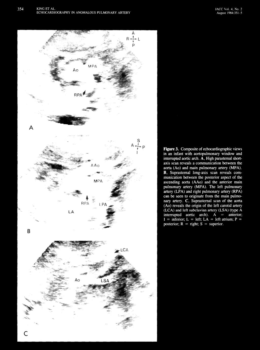 354 ECHOCARDlOGRAPHY IN ANOMALOUS PULMONARY ARTERY lacc Vol. 4, No.2 August 1984:351~5 Figure 3.