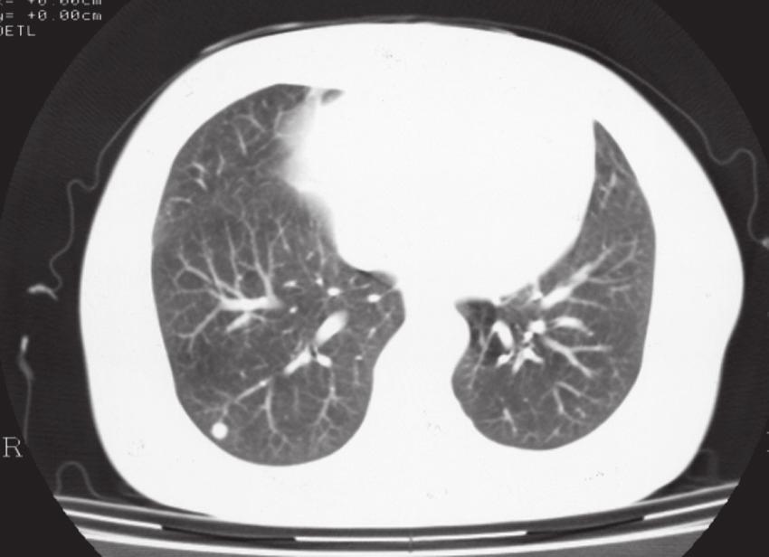 892 ITO et al. Fig. 2. Lung metastasis of patient 3 (arrowhead).