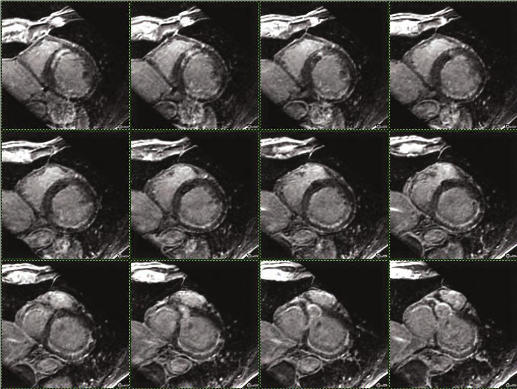 Clinical applications of 3D Heart 3D Heart can be used to assess proximal coronary arteries in a non-invasive, radiation-free manner.
