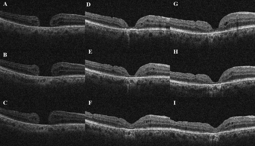 CAPSULAR TRANSPLANTATION IN MACULAR HOLE CHEN AND YANG 165 Fig. 1. A 62-year-old female patient (Case 13) had chronic MH for several years.