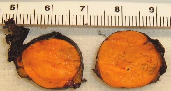 Primary Hyperaldosteronism Decoded: A Case of Curable Resistant Hypertension Figure 2. Gross pathology specimen showing a round, tan-orange, adrenal subcapsular mass (units on ruler are cm). Figure 3.