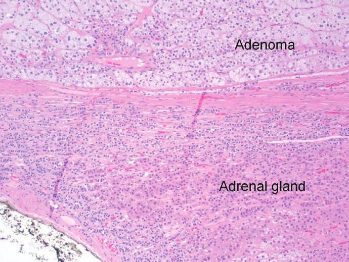 Microscopic examination revealed a circumscribed adrenal cortical neoplasm consistent with adenoma; there were no areas of necrosis or hemorrhage (Figure 3).