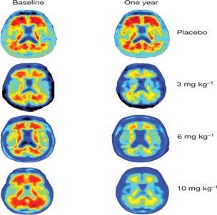 Amyloid plaque reduction with aducanumab & Aducanumab effect (change from