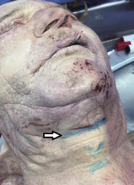 Vol. 43 / No. 4 / July 2016 Fig. 1. Incision, platysma dissection, and submandibular gland exposure (A) Skin markings over the submental incision, thyroid cartilage, and cricoid cartilage.